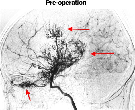 Moyamoya disease 